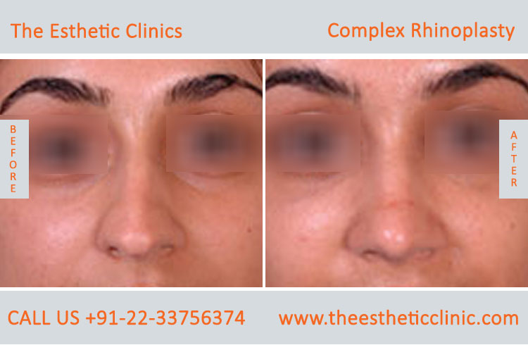 Complex Rhinoplasty, nose surgery before after photos in mumbai india (1)